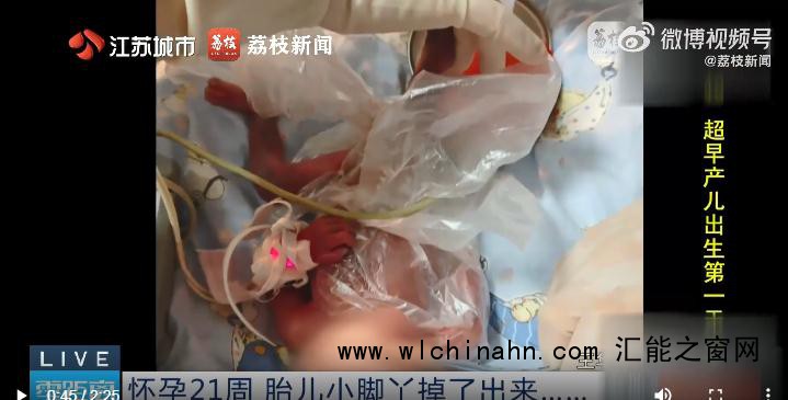 怀孕21周胎儿小脚丫掉了出来