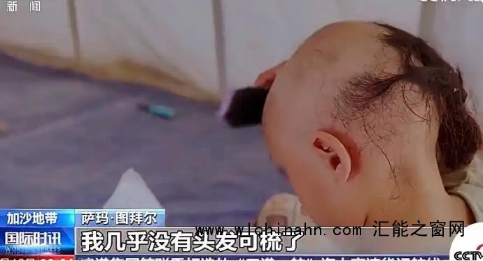 加沙8岁女孩逃难中几乎掉光头发