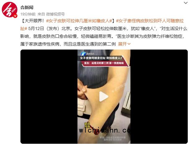 女子皮肤可拉伸几厘米如橡皮人