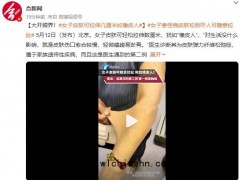 女子皮肤可拉伸几厘米如橡皮人 究竟发生了什么？