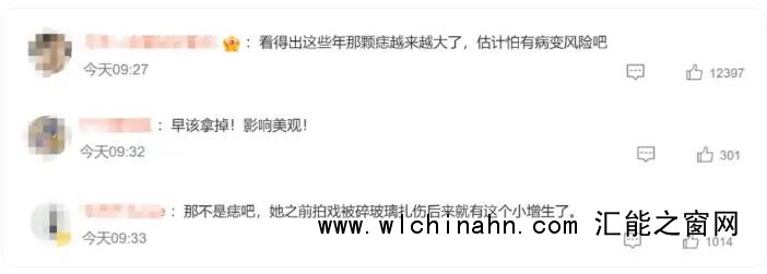 孙俪的唇下痣没了